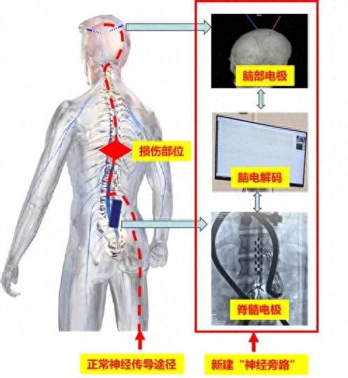 奇迹再现！上海医生让截瘫患者重新站立，背后的真相让人泪目！